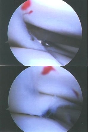 関節鏡で見た半月板損傷の手術の様子