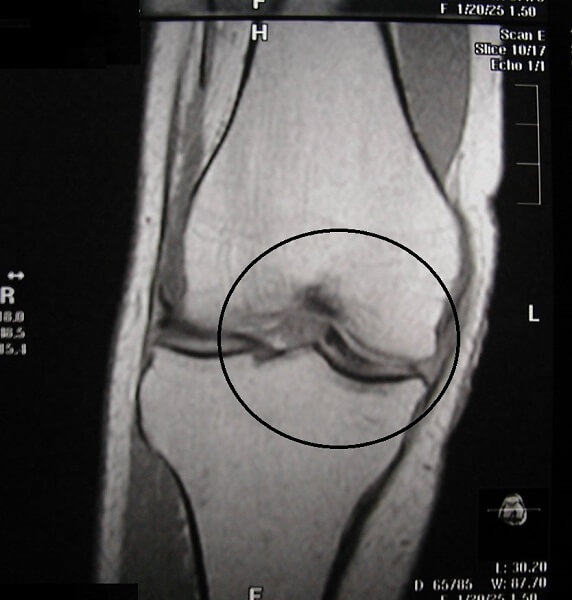 右膝のMRI