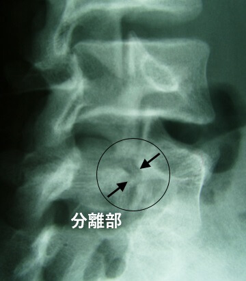 腰椎分離症3