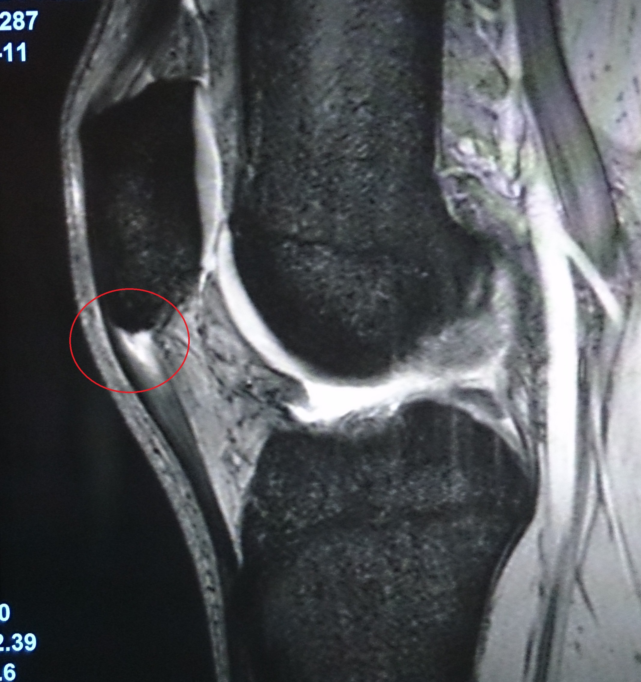 ジャンパー膝 MRI