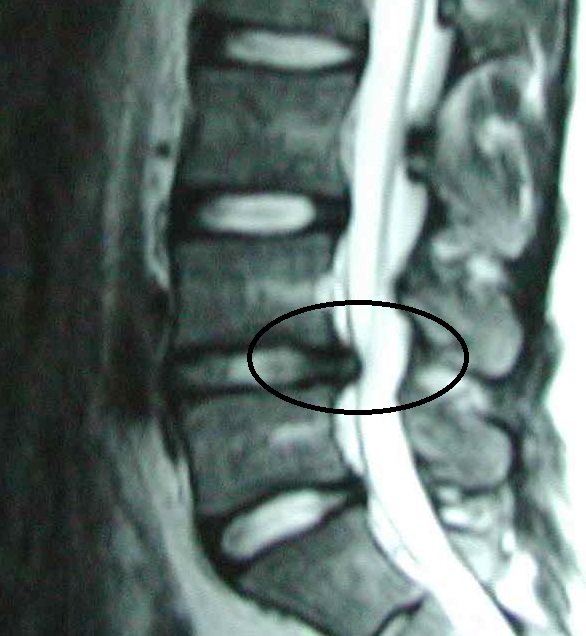 椎間板ヘルニア MRI