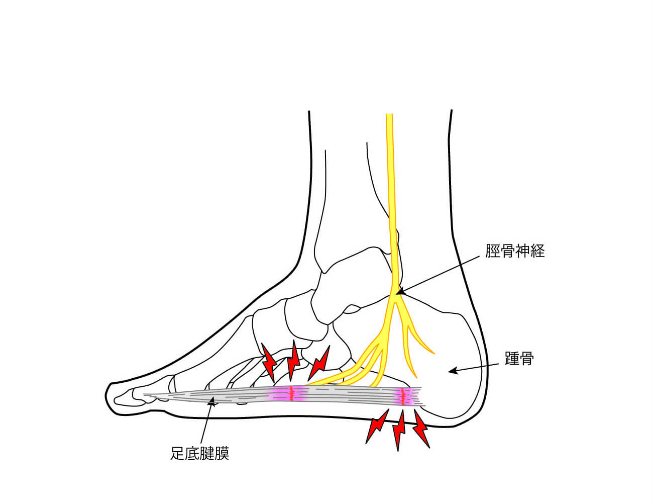 足底腱膜炎