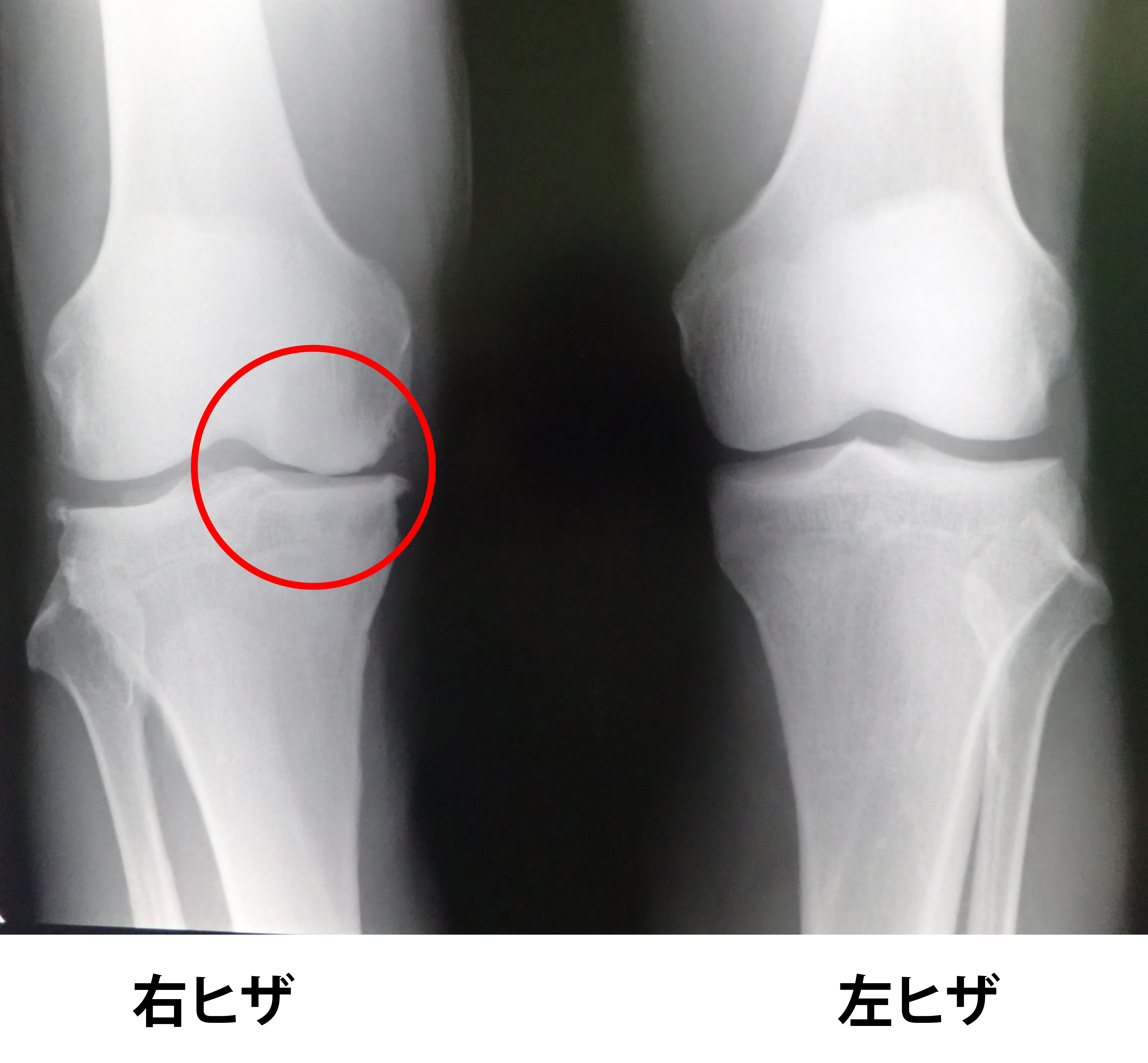 軟骨が摩耗して、内側の関節面が狭くなっている